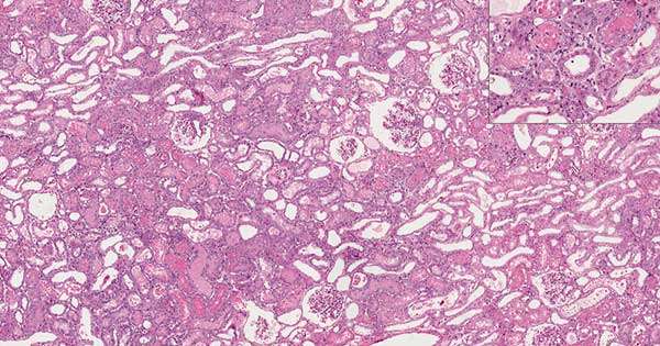 Necrosis tubular aguda