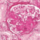 Glomerulonefritis