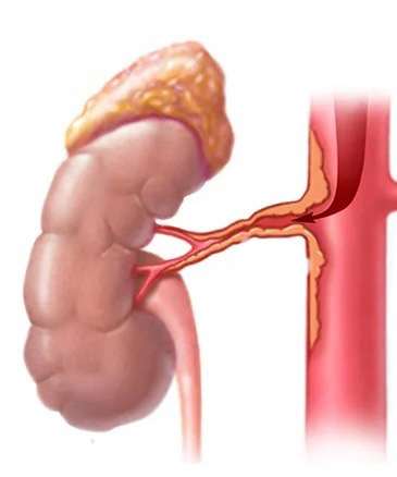 Estenosis de la arteria renal