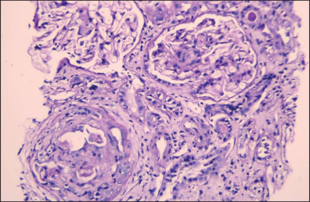 Glomerulonefritis Pauciinmune (Asociada a ANCA)