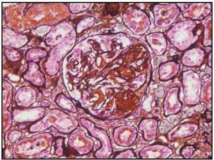 Glomerulonefritis por Inmunoglobulina Monoclonal