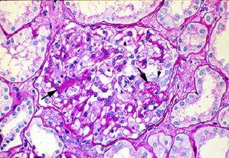 Enfermedades glomerulares del espectro nefrótico