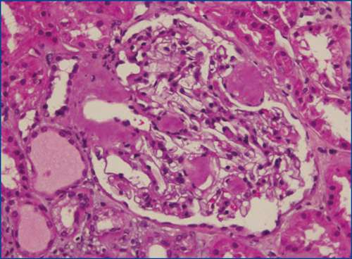 ¿Qué es la amiloidosis renal?