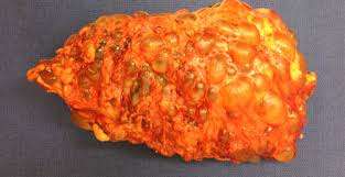 Características clínicas de las enfermedades quísticas del riñón