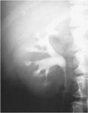 Riñón esponjoso medular