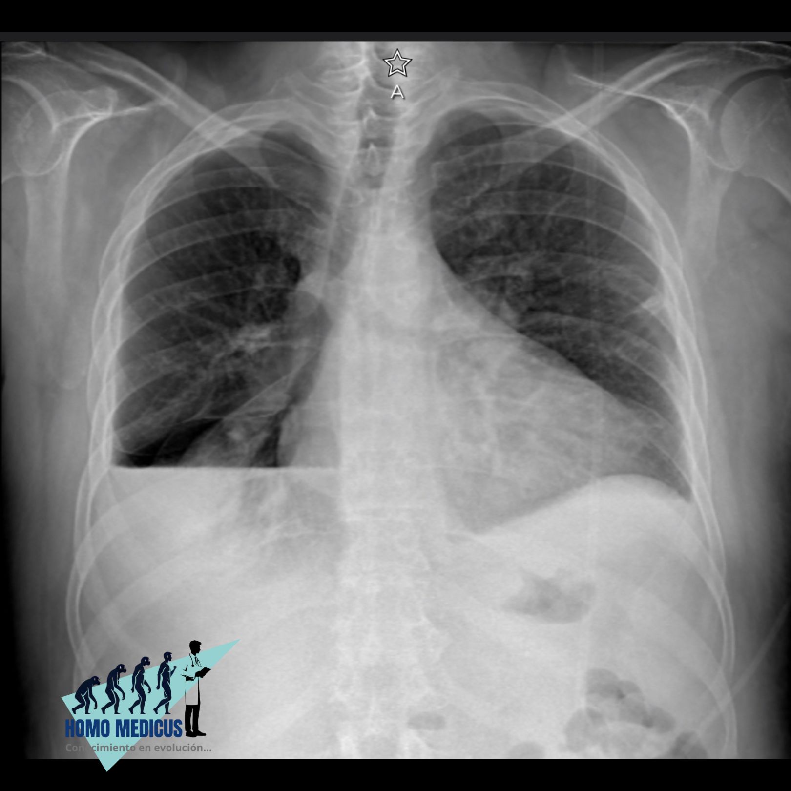 Derrame pleural