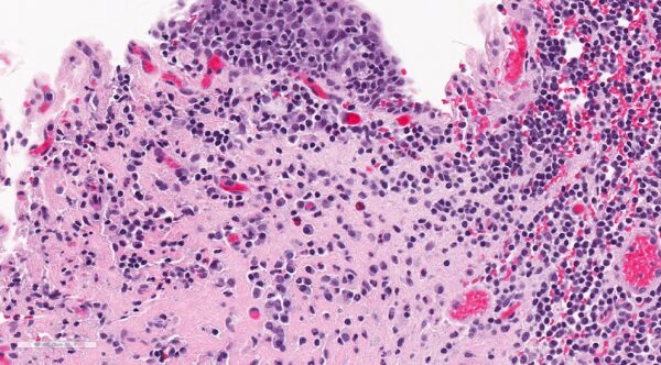 Cistitis intersticial