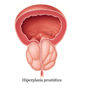 Hiperplasia prostática benigna