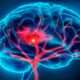 ¿Qué es un accidente cerebrovascular?