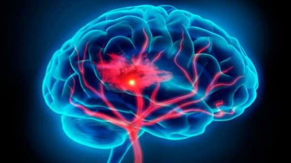 ¿Qué es un accidente cerebrovascular?