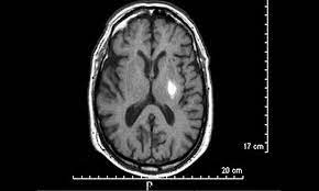 ¿Qué es un infarto lacunar?