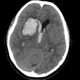 Hemorragia intracerebral
