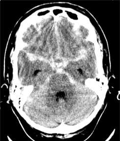 Hemorragia subaracnoidea espontánea