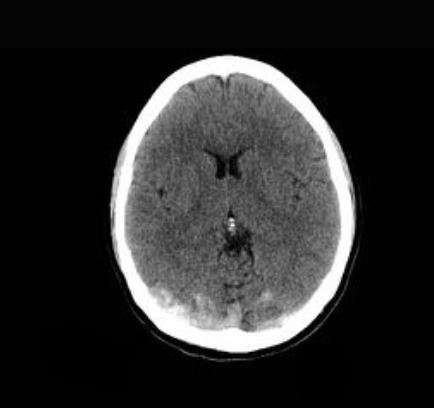 Trombosis venosa intracraneal