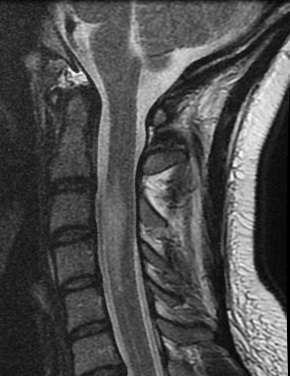 ¿Qué es el Infarto de la médula espinal?