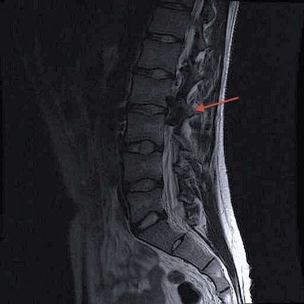 ¿Qué son las fístulas arteriovenosas espinales durales?