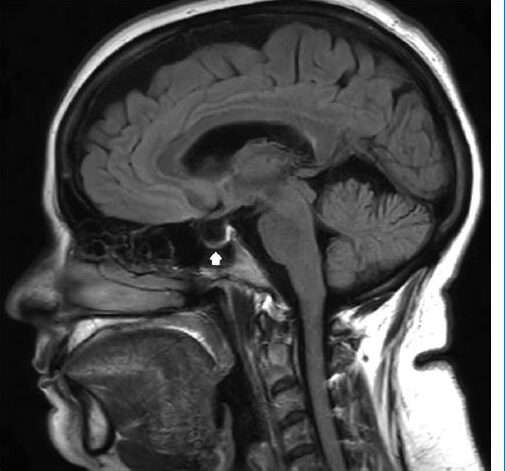 Hipertensión intracraneal idiopática