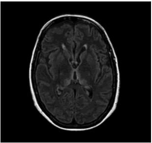 ¿Qué es la encefalopatía de Wernicke?