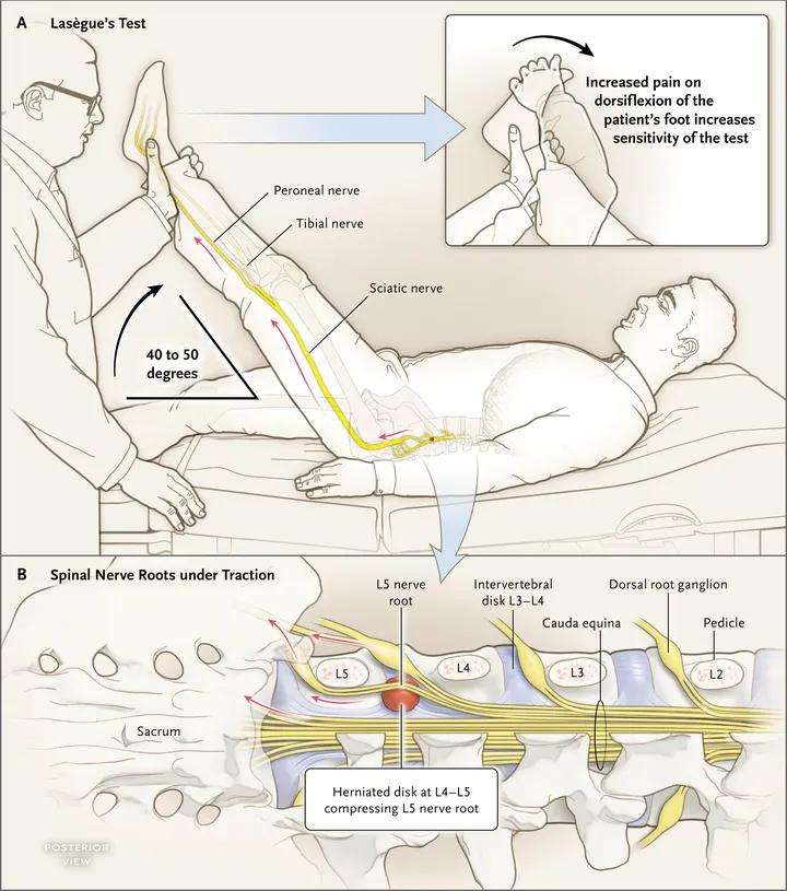 ¿Cuál es la prueba de Lasègue?
