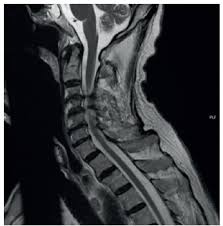 degeneración combinada subaguda de la médula espinal