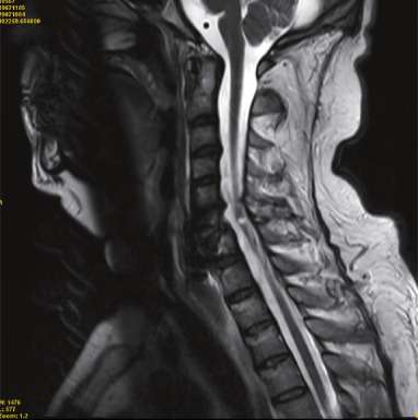 Lesión traumática de la médula espinal