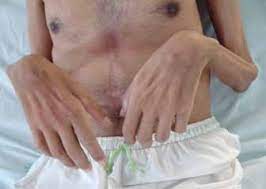 ¿Qué son las Neuropatías tóxicas?