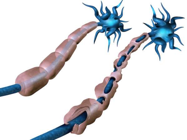 Polineuropatía idiopática aguda (síndrome de Guillain-Barré)