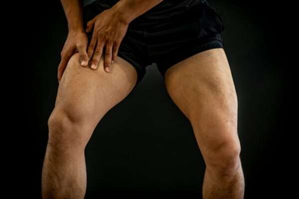 ¿Qué es la Neuropatía Femoral?