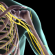 Neuropatía del plexo braquial