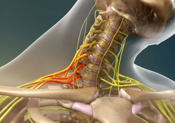 Síndrome de la costilla cervical