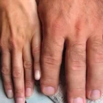 Acromegalia y gigantismo