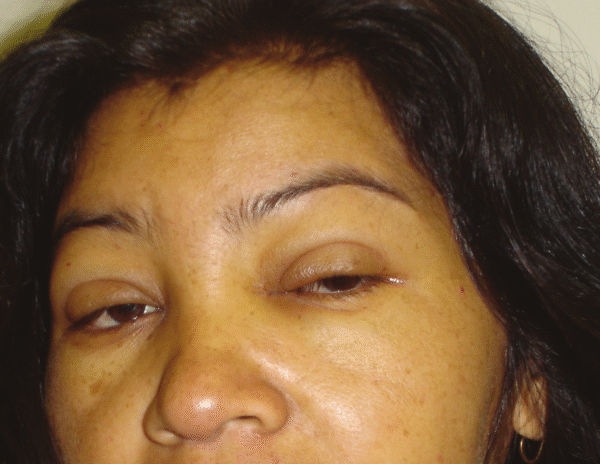 Hipotiroidismo y mixedema