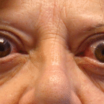 Oftalmopatía tiroidea