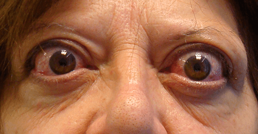 Oftalmopatía tiroidea