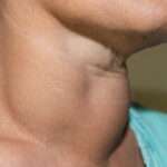 Nódulos tiroideos y bocio multinodular