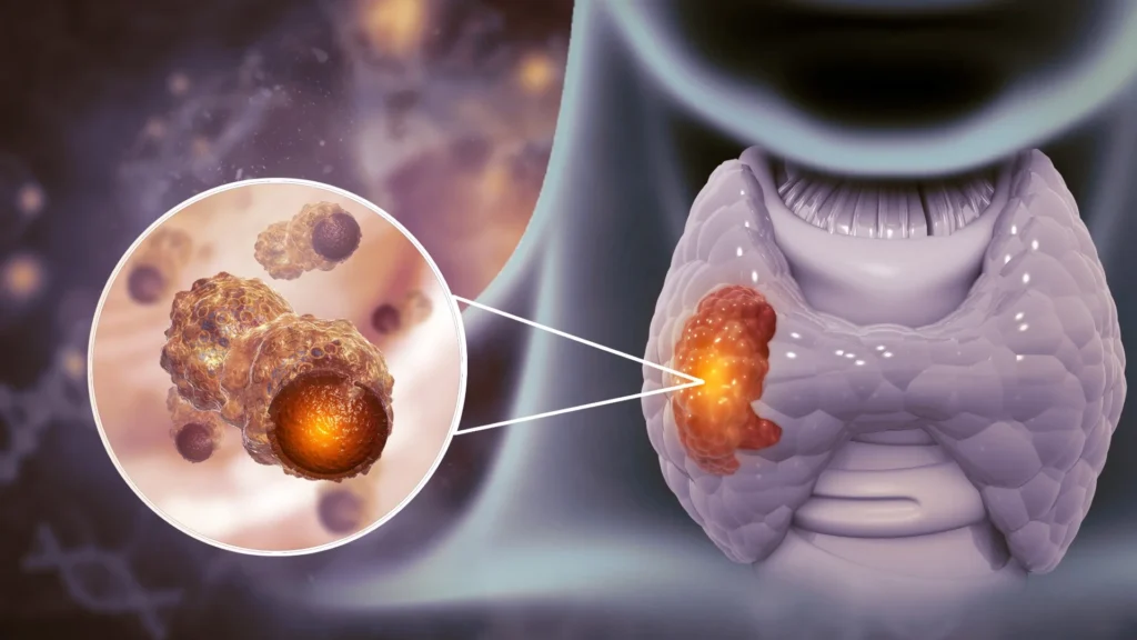 Cáncer de tiroides