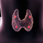 Hipoparatiroidismo y seudohipoparatiroidismo