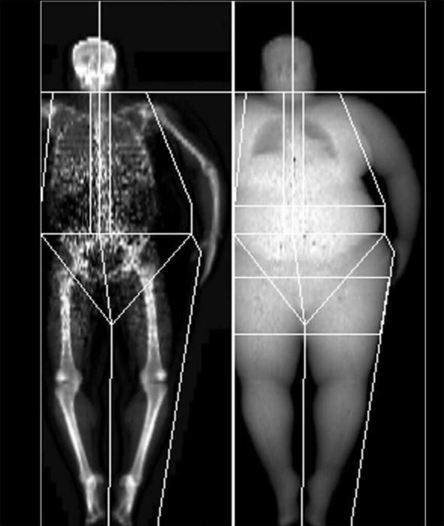 Enfermedad ósea metabólica
