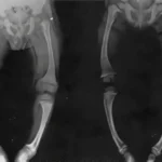 Raquitismo y Osteomalacia