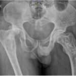 enfermedad de Paget del hueso