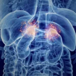 Insuficiencia suprarrenal primaria (Enfermedad de Addison)