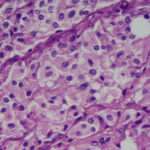 Feocromocitoma y Paraganglioma