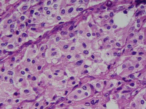 Feocromocitoma y Paraganglioma
