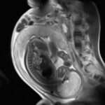 Feocromocitoma en el embarazo