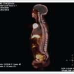Feocromocitoma y Paraganglioma Metastásicos