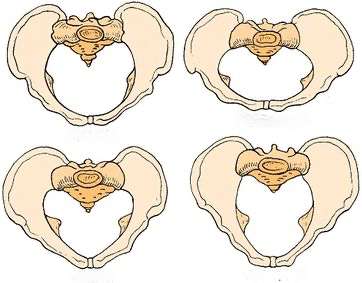 Clasificación de la pelvis según Thoms