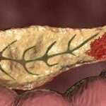 Hipoglucemia debida a tumores de células beta pancreáticas