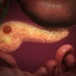 Hipoglucemia por tumor de células no insulares