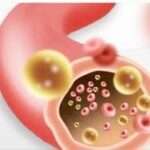 ¿Cómo se manifiestan las dislipidemias?