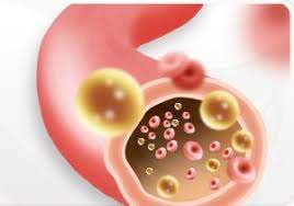 ¿Cómo se manifiestan las dislipidemias?